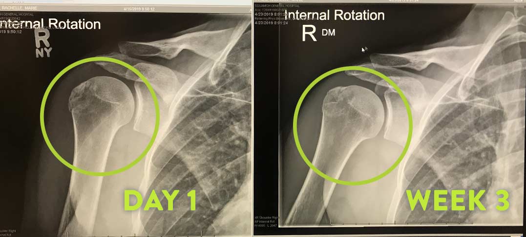 how-to-heal-bones-wounds-faster-x-ray-zesty-life-mountain-biking
